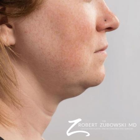 CoolSculpting®: Patient 1 - After Image 2
