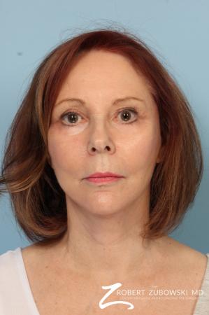 Facelift: Patient 17 - After Image 1
