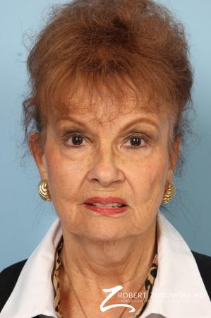 Facelift: Patient 24 - Before Image 1