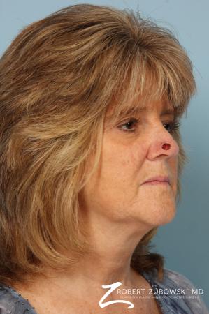 Mohs Closure: Patient 5 - Before and After Image 2