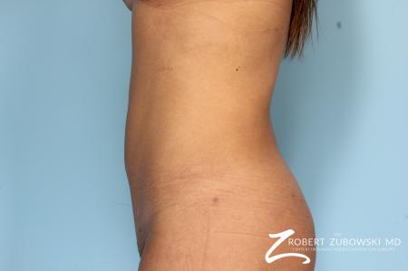 Liposuction: Patient 12 - After Image 1