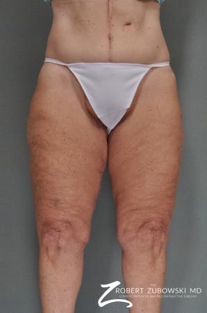 Thigh Lift: Patient 1 - After Image 1