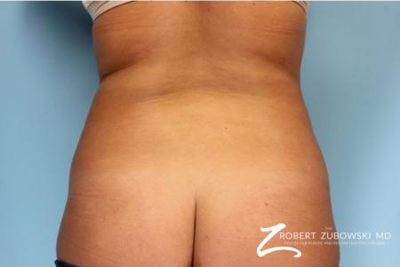 Liposuction: Patient 37 - Before Image 1