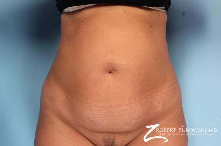 Tummy Tuck: Patient 9 - Before Image 1