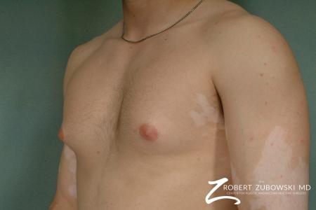 Gynecomastia: Patient 5 - Before and After Image 2