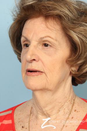 Blepharoplasty: Patient 36 - After Image 3