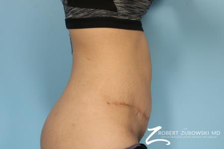 Tummy Tuck: Patient 24 - After Image 1