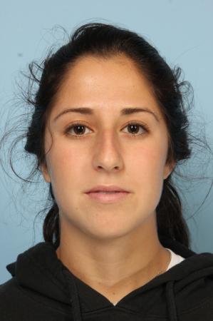 Rhinoplasty: Patient 20 - Before Image 1