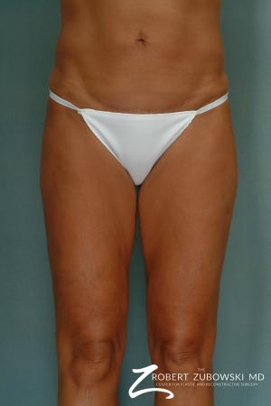 Liposuction: Patient 33 - After Image 2