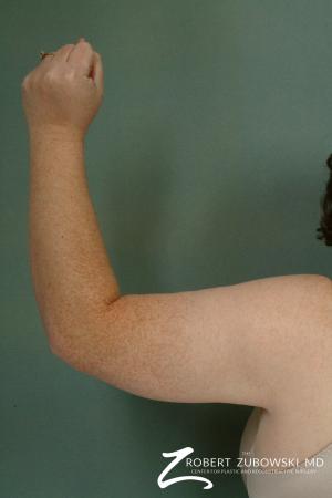 Arm Lift: Patient 3 - After Image 2