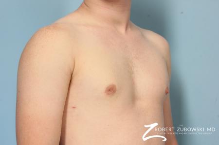 Gynecomastia: Patient 11 - After Image 2