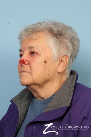 Mohs Closure: Patient 3 - Before and After Image 2