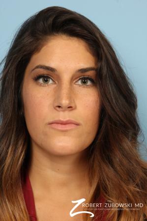 Rhinoplasty: Patient 19 - After Image 1