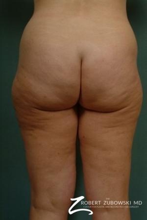 Liposuction: Patient 6 - Before and After Image 2