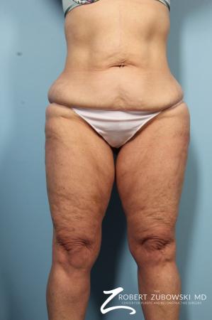 Body Lift: Patient 5 - Before Image 1