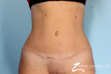 Tummy Tuck: Patient 9 - After Image 1