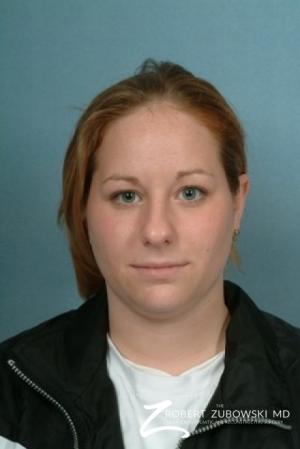 Rhinoplasty: Patient 5 - Before Image 1