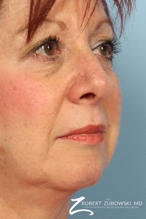 Mohs Closure: Patient 2 - After Image 1