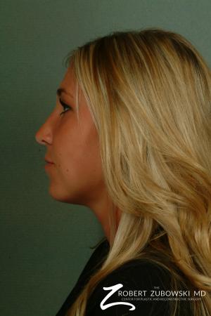 Rhinoplasty: Patient 1 - After Image 2