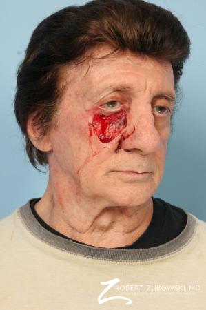 Mohs Closure: Patient 4 - Before Image 1