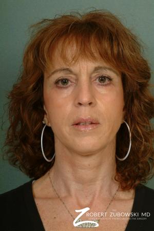 Chemical Peel: Patient 3 - After Image 1