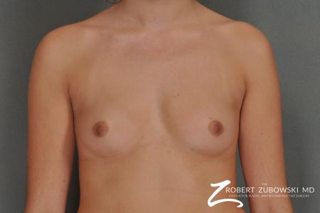 Breast Augmentation: Patient 15 - Before Image 1