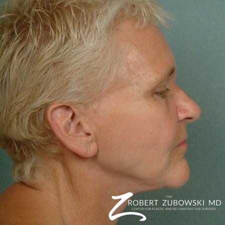 Facelift: Patient 14 - After Image 2
