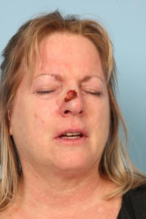 Mohs Closure: Patient 1 - Before Image 2
