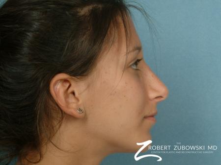 Rhinoplasty: Patient 8 - After Image 2