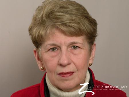 Blepharoplasty: Patient 20 - Before Image 1