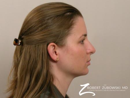 Chin Augmentation: Patient 1 - After Image 2