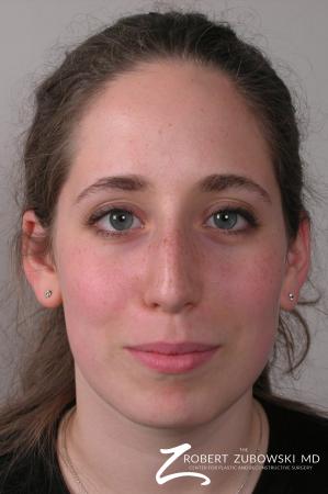 Rhinoplasty: Patient 7 - Before Image 1