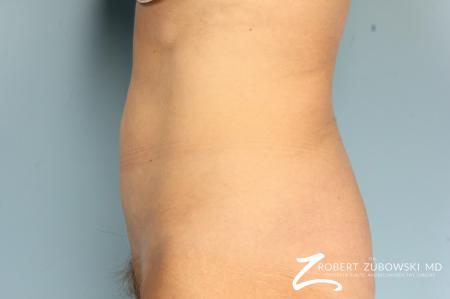 CoolSculpting®: Patient 4 - After Image 2