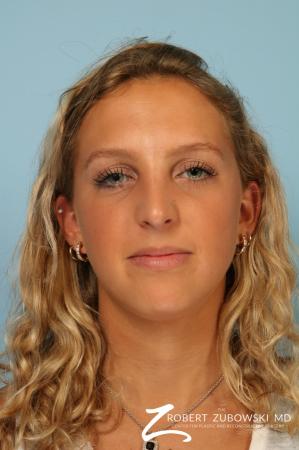 Rhinoplasty: Patient 22 - After Image 1