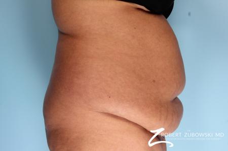 Tummy Tuck: Patient 19 - Before and After Image 2