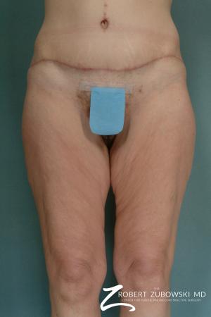 Body Lift: Patient 2 - After Image 1