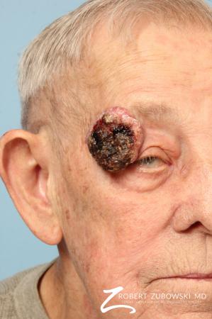 Mohs Closure: Patient 7 - Before Image 2