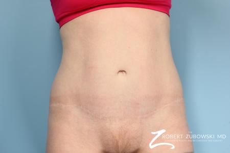 Tummy Tuck: Patient 5 - After Image 1