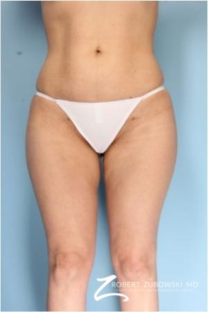 Liposuction: Patient 42 - After Image 1