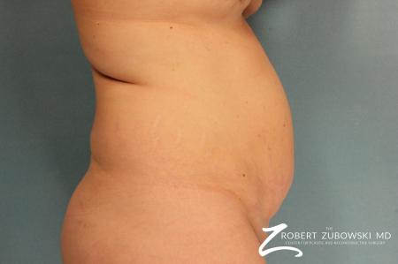 Tummy Tuck: Patient 13 - Before and After Image 2