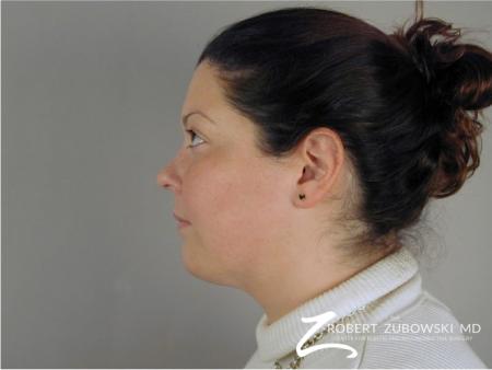 Liposuction: Patient 43 - After Image 1