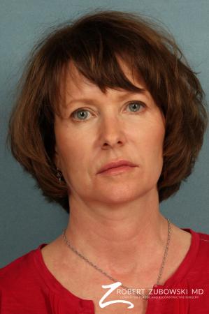Ultherapy®: Patient 1 - Before Image 1