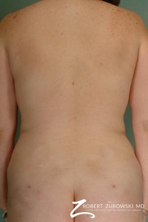 Liposuction: Patient 25 - After Image 1