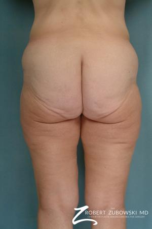 Body Lift: Patient 2 - Before and After Image 2