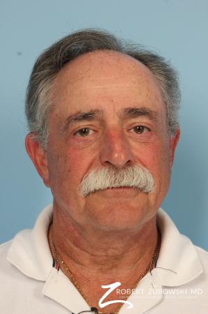 Neck Lift: Patient 6 - After Image 1