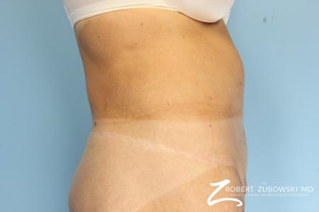 CoolSculpting®: Patient 2 - After Image 2