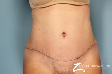 Tummy Tuck: Patient 16 - After Image 1