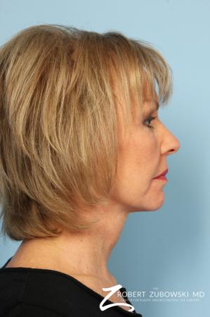 Facelift: Patient 3 - After Image 2