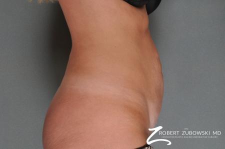 Tummy Tuck: Patient 10 - Before and After Image 2