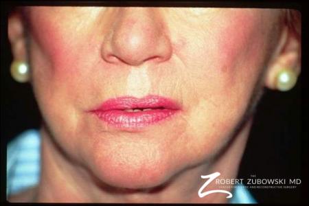 Laser: Patient 8 - After Image 1